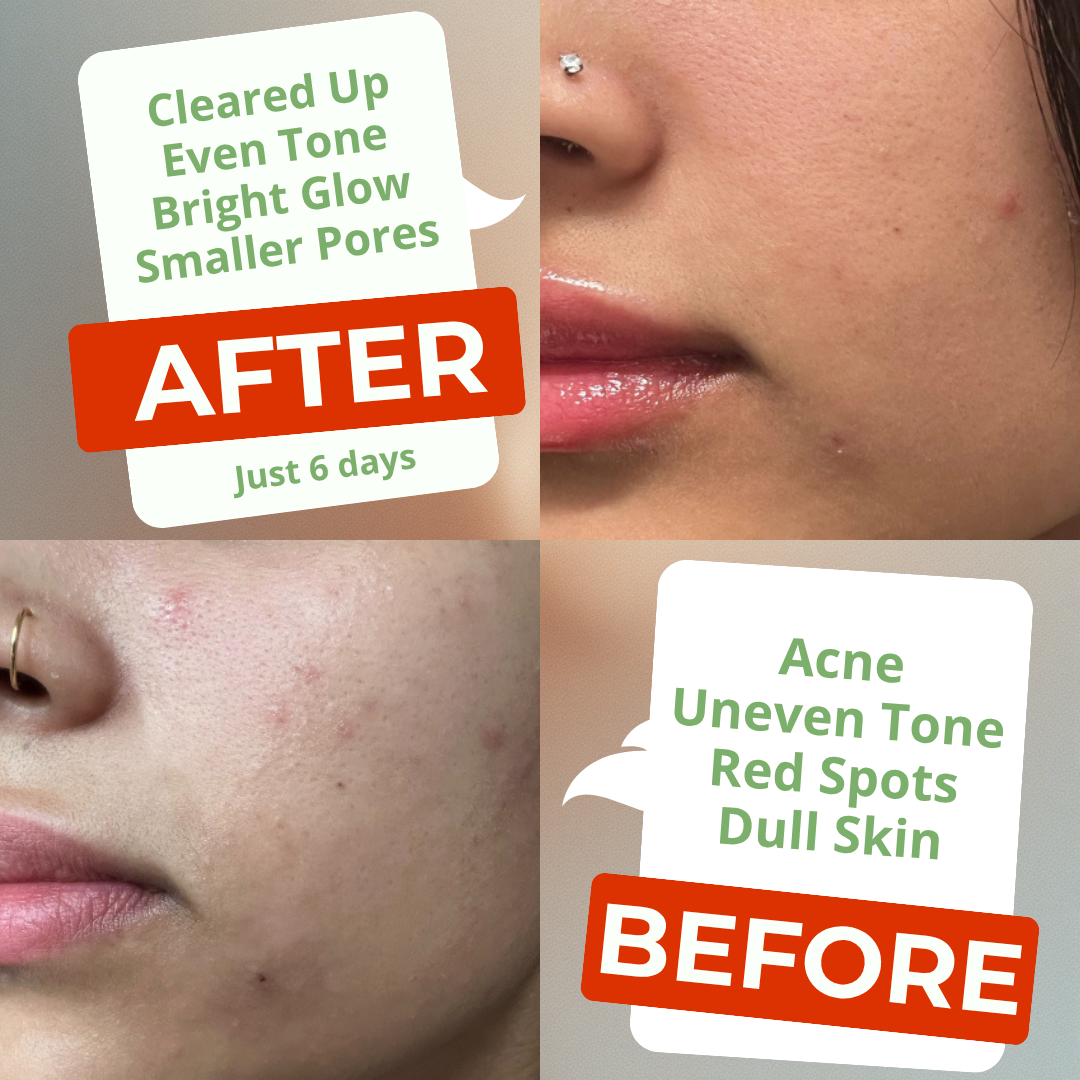 Arbutin 7% + Tranexamic Acid 4% Cream