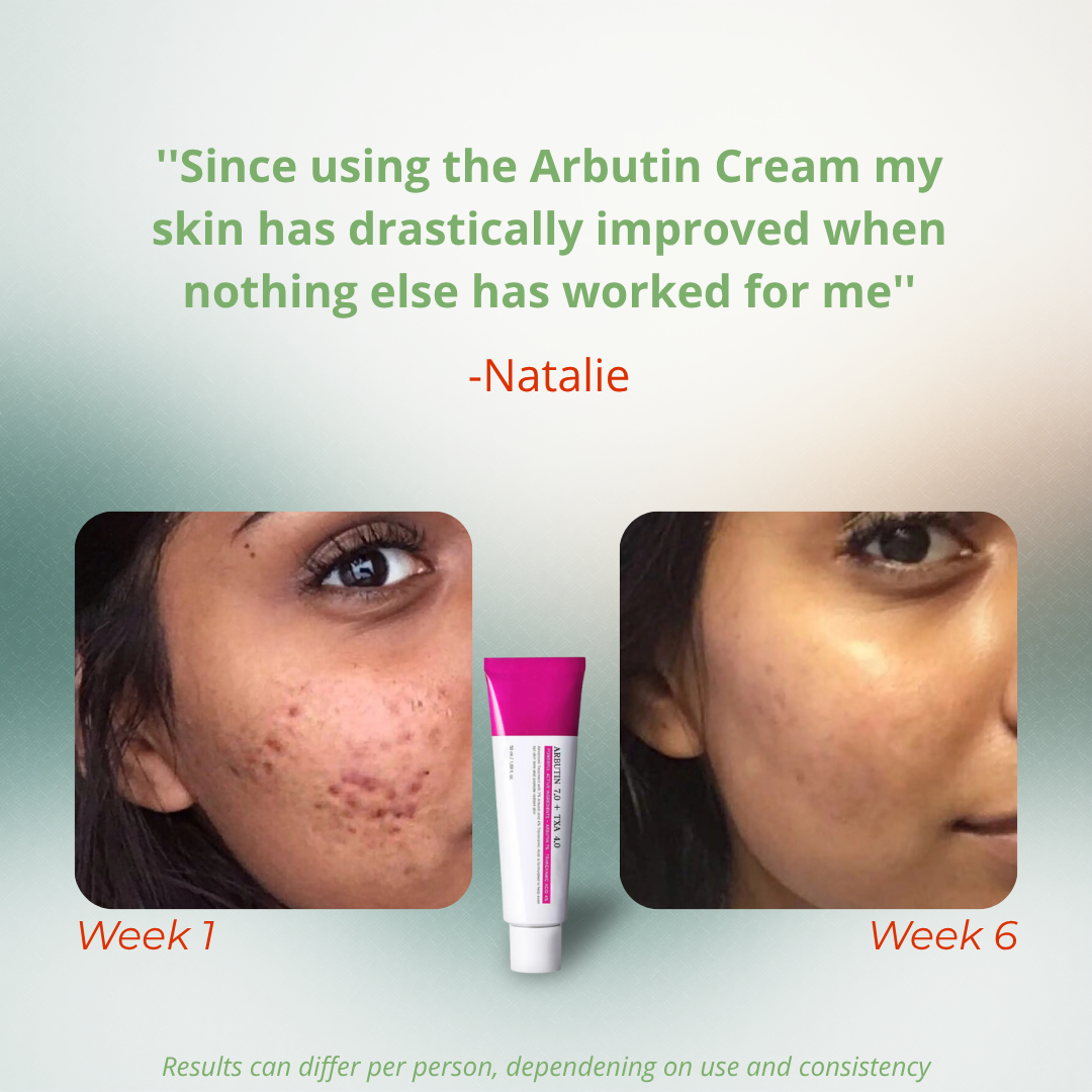 Arbutin 7% + Tranexamic Acid 4% Cream