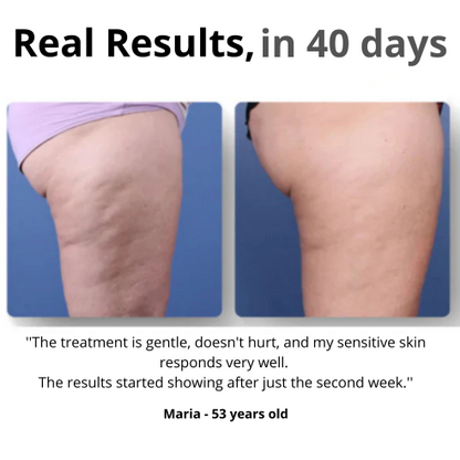 K-BEAUTY Cellulite Massager